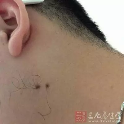 5、女人喉结有痣运势:女生喉结下方正中有痣代表什么