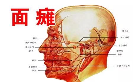 1、面瘫会影响运势吗:面瘫的危害有哪些