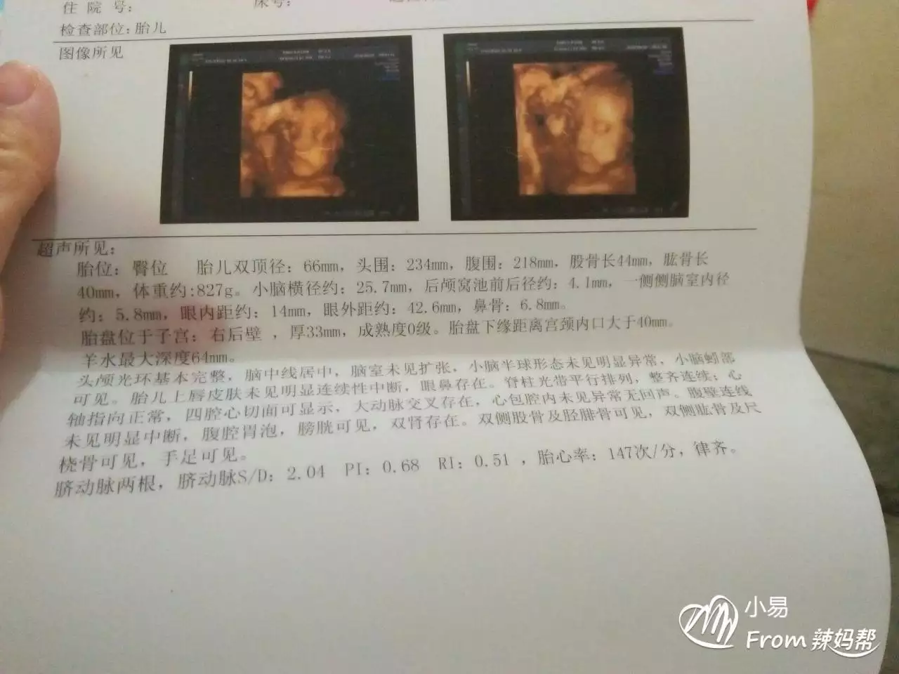 3、已生了女宝的四维单子:想知道是宝还是女宝宝?四维彩超声24周大小单子详细如下