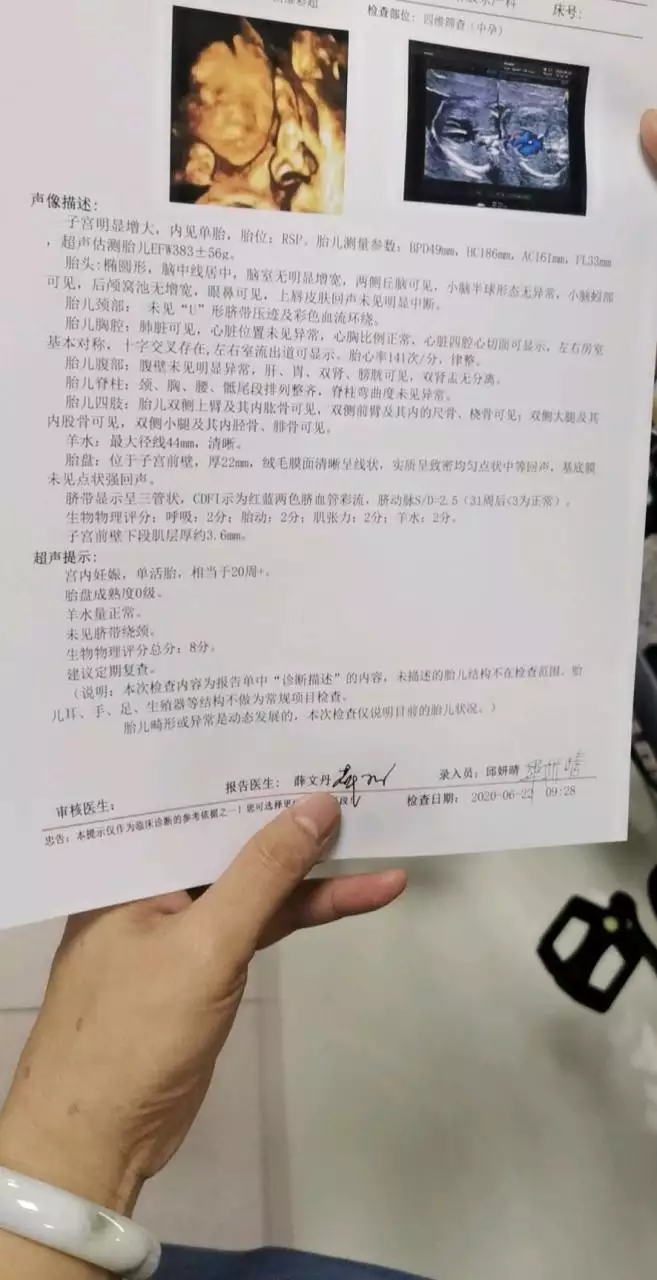 4、已生女孩四维彩超图片:做b超查男女说有三角形三个亮点,一个蜡烛样的,是男孩么?