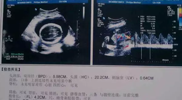 3、：丹田在脐下一寸三分的地方，还是平躺的脐下一寸三分（脐内）？