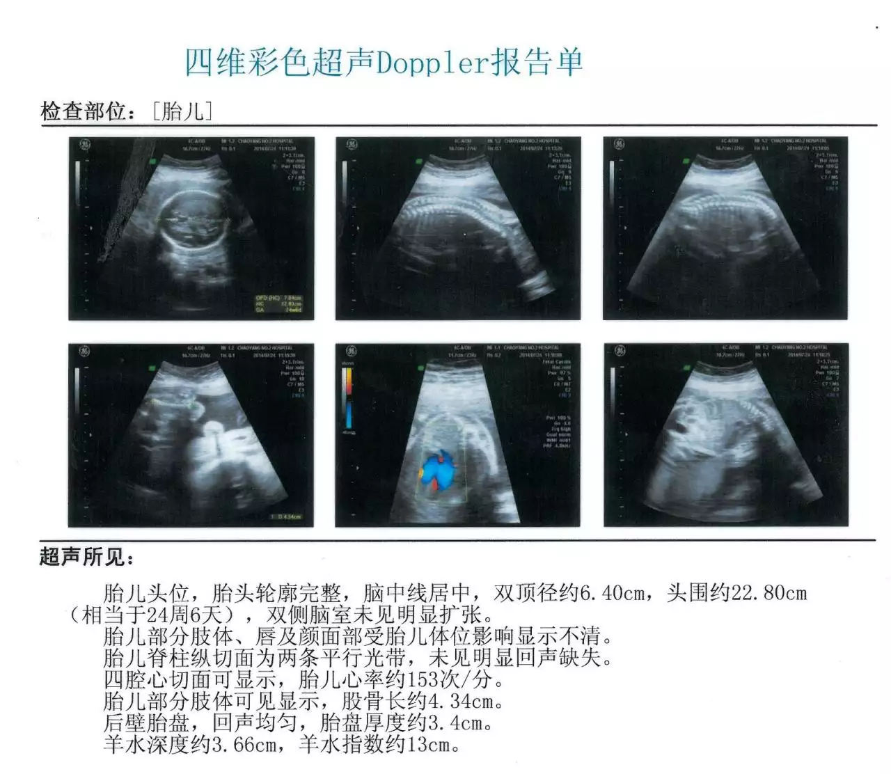 1、四维彩超胎儿图片:做b超查男女说有三角形三个亮点,一个蜡烛样的,是男孩么?