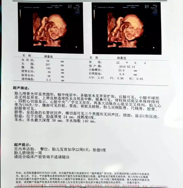 1、四维彩超图片:胎宝宝的四维彩超照片很丑，是不是出生后也会很丑？