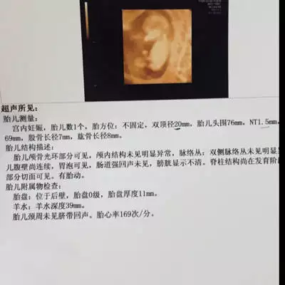 3、怀孕几周能检查出男女:十月怀生女儿多还是儿子多