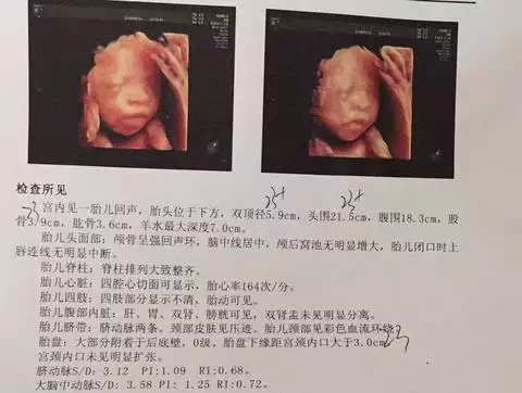 1、生女孩的四维彩超单子图片:四维彩超单怎么看是男孩还是女孩？