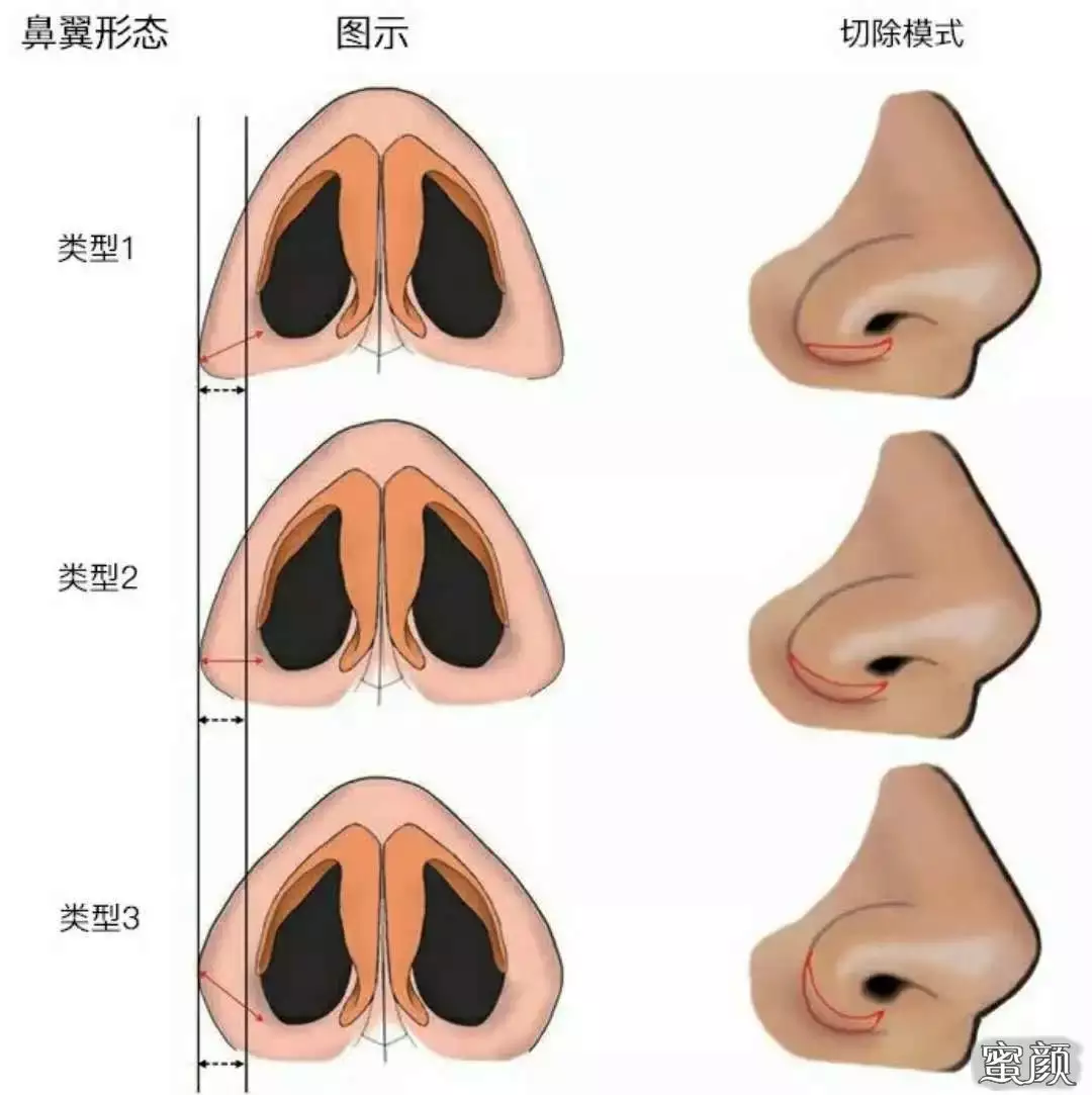 5、测试你是不是塌鼻子:怎么样算是塌鼻子