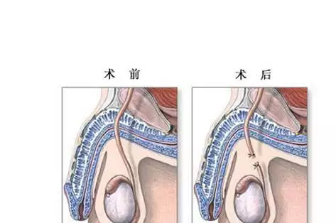 3、男人结扎还有性需求吗:如果男人结扎了还有性 生活吗？