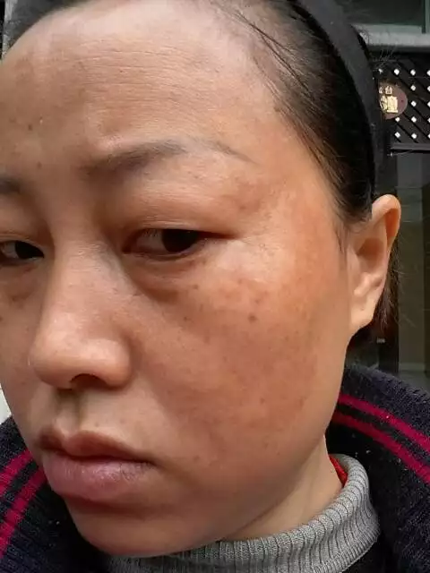 3、女人脸上长斑是什么造成的:女性脸上长斑是什么原因