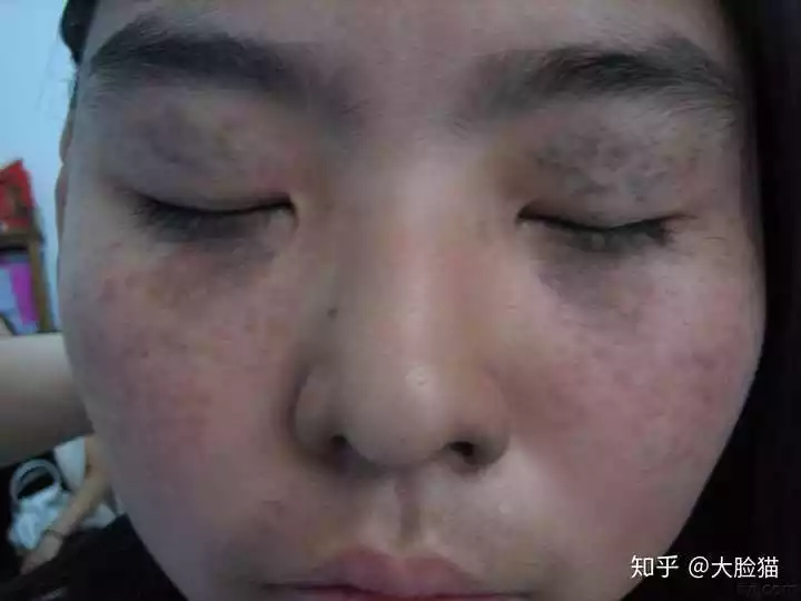 3、脸上长斑和夫妻生活有关吗:女人脸上长斑与有关吗