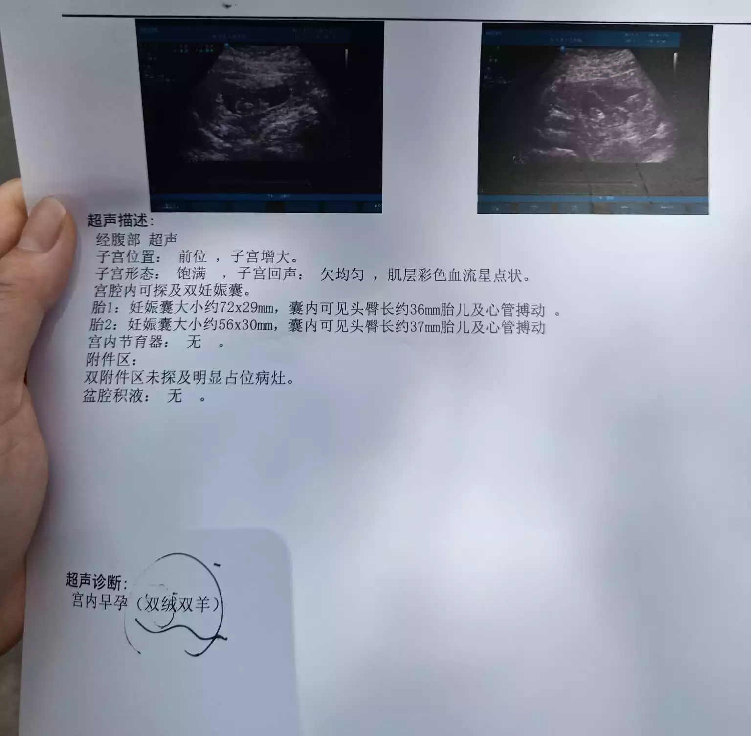 2、b超孕囊2个数看性别:怀孕9周+1的孕囊，是圆形还是茄子形状？