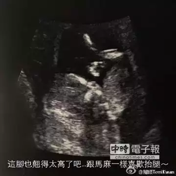 2、怀孕b超单子怎么看:孕期B超单怎么看