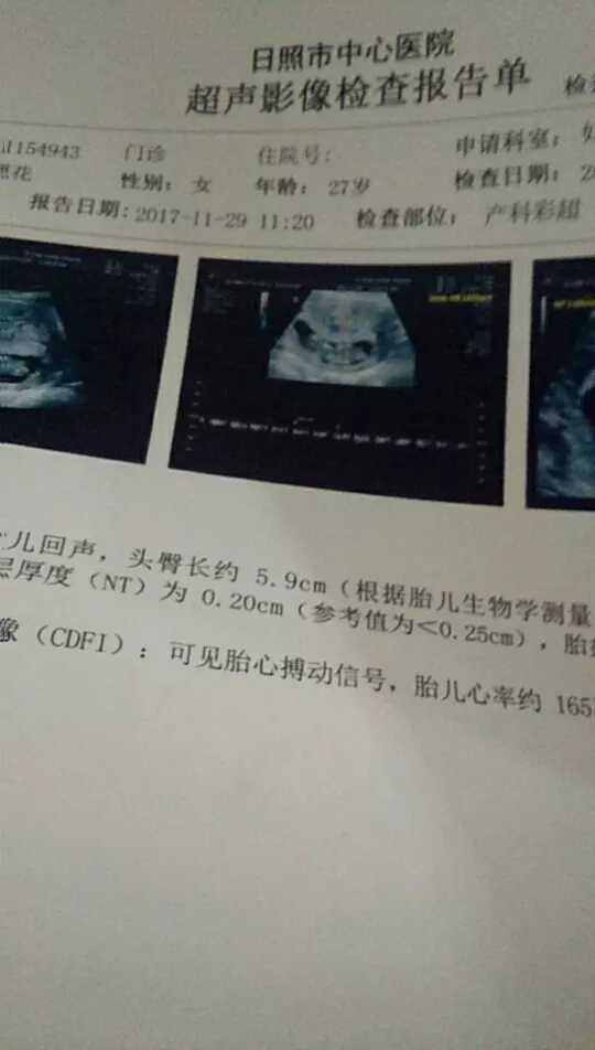 3、hcgb校正值4.45偏高，导致21三体综合征高风险，其他都正常。医生建议做无创DNA，怎么办？