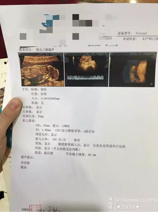 3、nt单可看男女准确率90:看NT单子能看出男女吗？