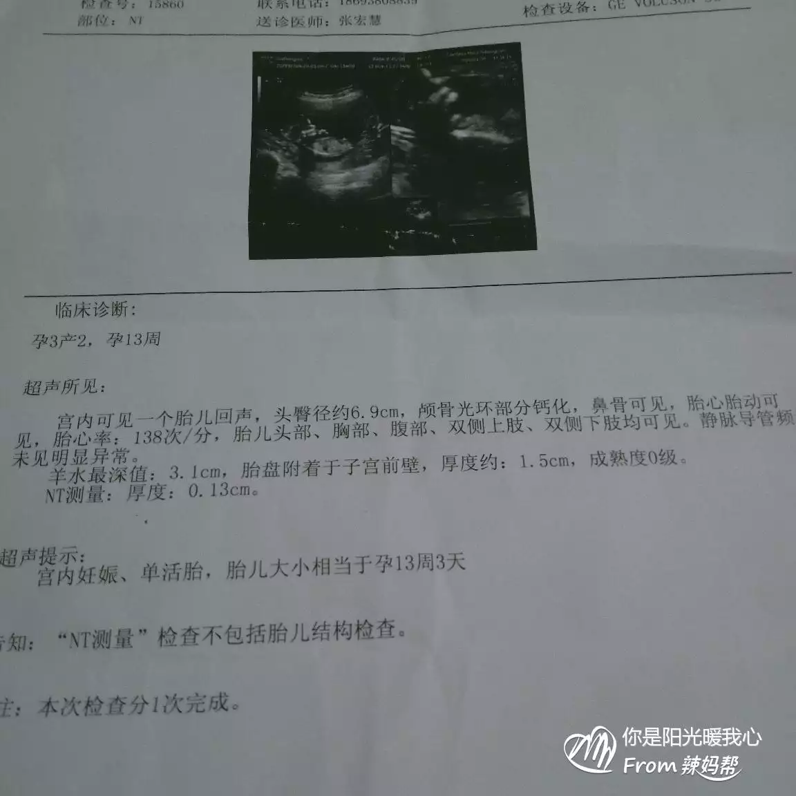 4、nt单可看男女准确率90:做nt可以看出男女吗