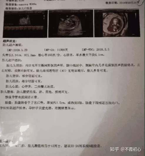 7、四维单子3秒钟看男是女:四维彩超单怎么看是男孩还是女孩？