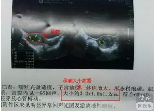 3、孕囊尺寸三个数据图解看男孩:怀男孩BC数据是多少