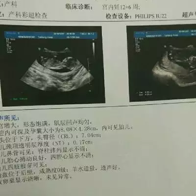 2、怀女宝物不一样:老人真的一眼就能看出怀的是男孩还是女孩吗？