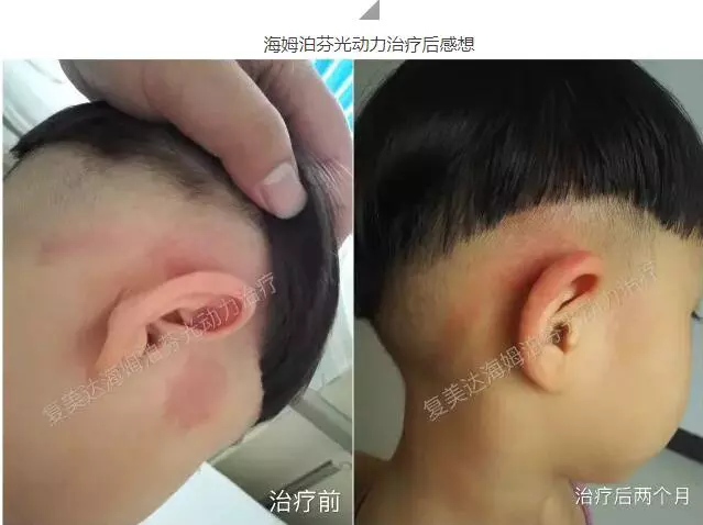 孩子生下来脸上有胎记是什么原因：宝宝生下来脸上有胎记，这种应该怎么办？