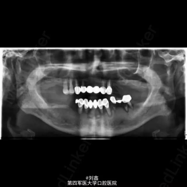 男人下牙掉一颗代表什么：己婚男人掉个小牙是什么意思