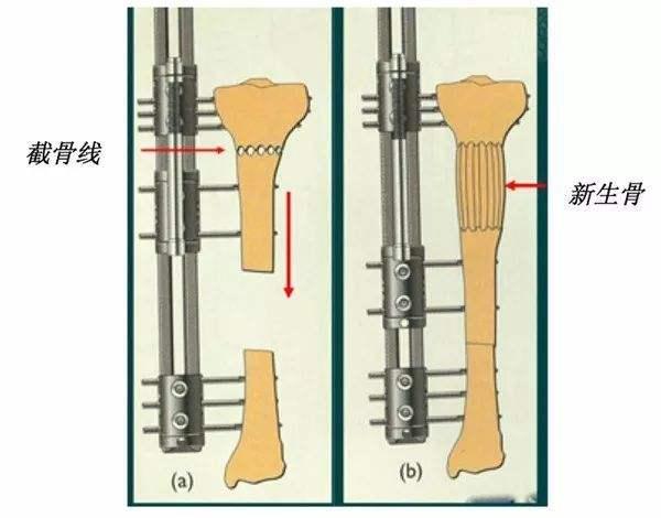 八字钢板骨骺阻滞术
