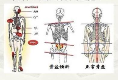 八字钢板骨骺阻滞术