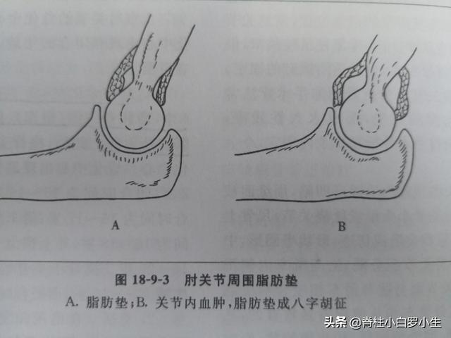 八字征阳性