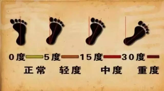 跑步是内八字