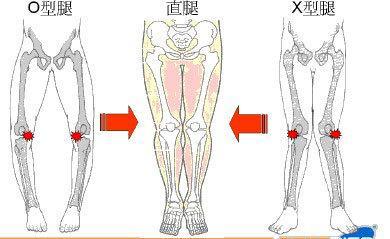 孩子内八字怎么办