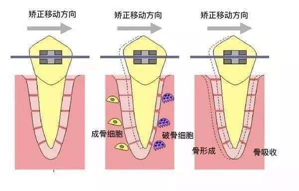 正畸八字结扎了