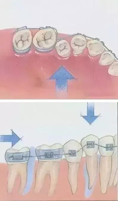 正畸八字结扎了