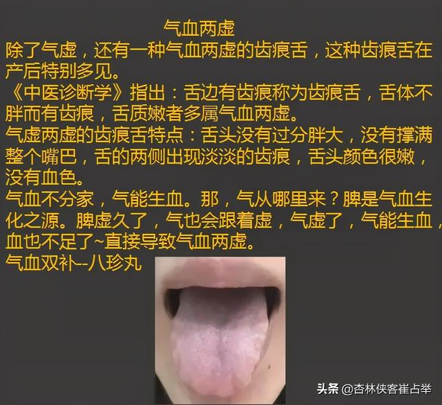 舌头有齿痕是怎么回事有个八字