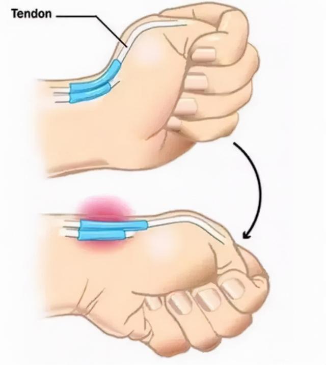 八字疗法腱鞘炎