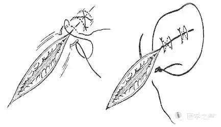 临床八字缝合法视频 内八字缝合法