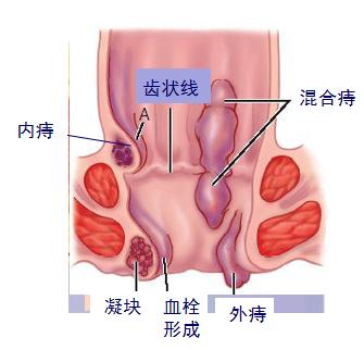 八字疗法痔疮对应图