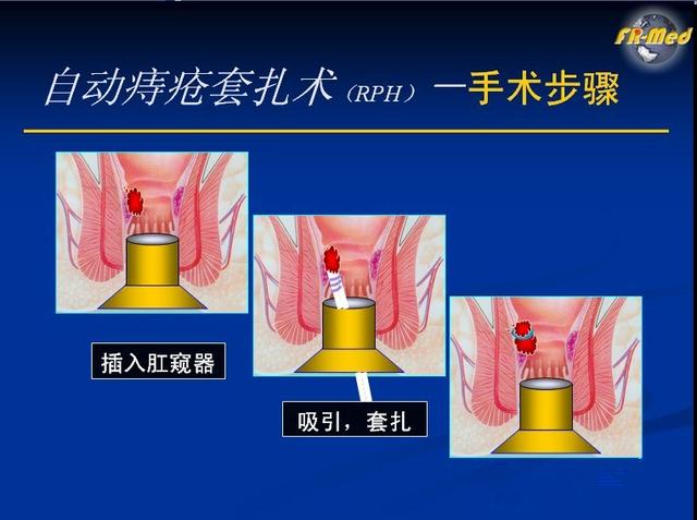 八字疗法痔疮对应图