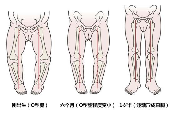 两岁宝宝八字腿严重