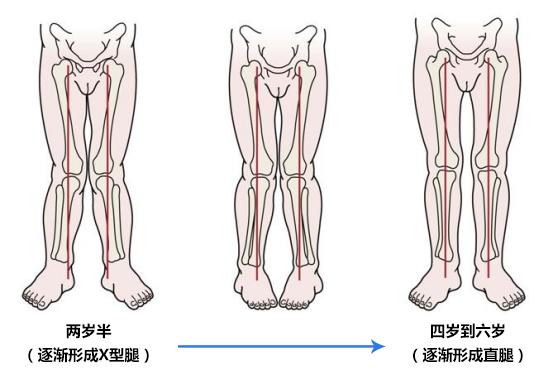 两岁宝宝八字腿严重