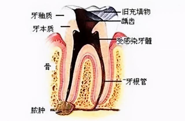 牙齿松动修复八字结扎