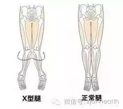 宝宝刚走路八字腿正常吗