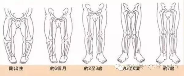 宝宝刚走路八字腿正常吗