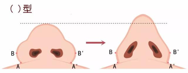 鼻子两侧八字纹肥厚