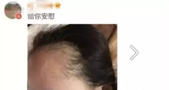 什么样八字容易秃顶