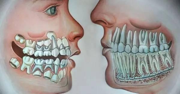 儿童换牙门齿八字不齐怎么办