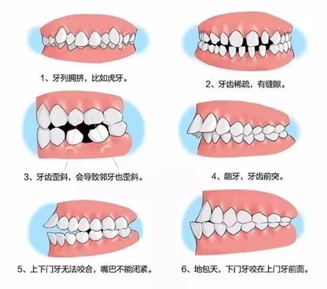 儿童换牙门齿八字不齐怎么办