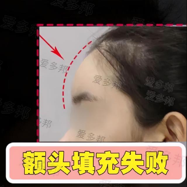 自体脂肪填充八字纹有硬结