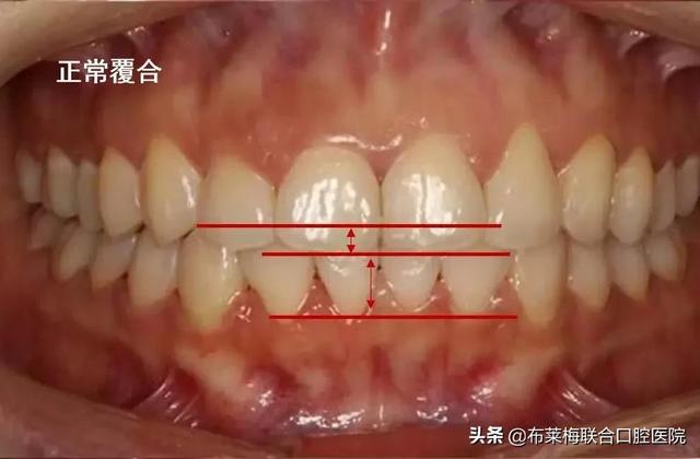 尖牙和后牙八字结扎