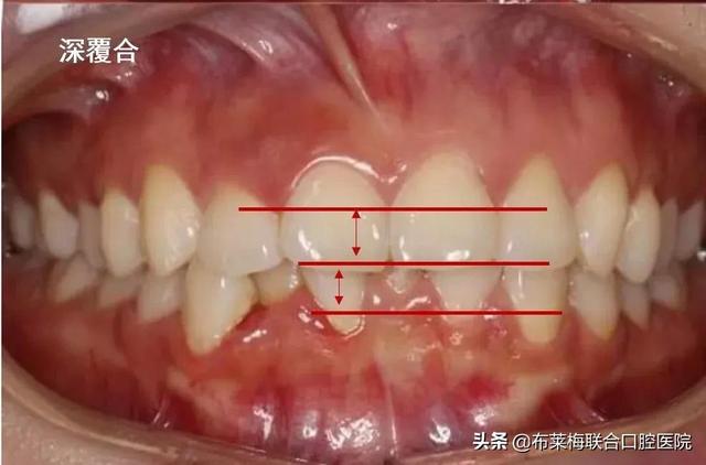 尖牙和后牙八字结扎