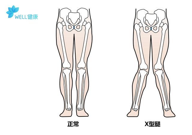 儿子2岁内八字又查出长短腿