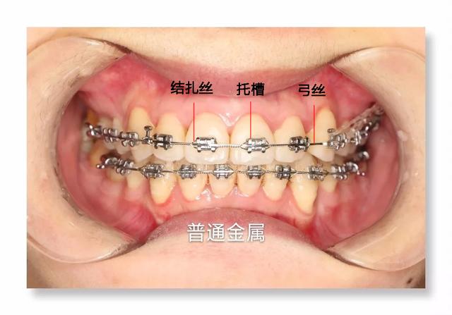 正畸八字结扎法图解