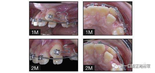 正畸尖牙八字结扎，正畸八字结扎法